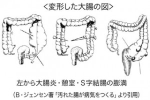 変形した大腸の図